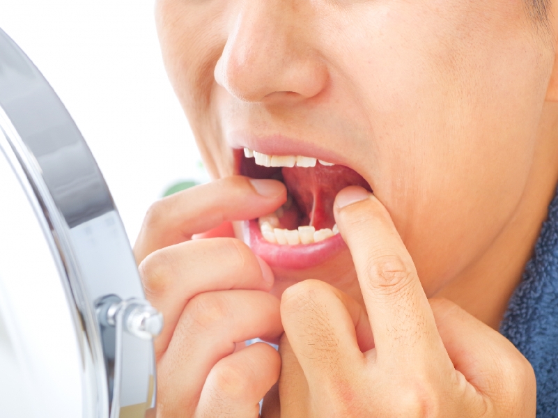 歯周疾患の治療